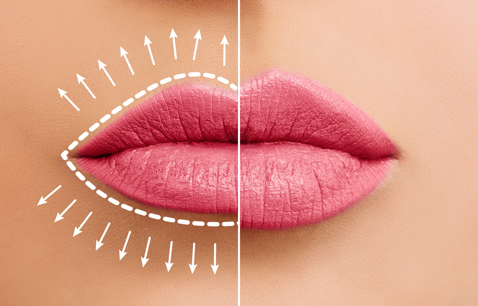 Lip augmentation concept. Woman lips before and after lip filler injections