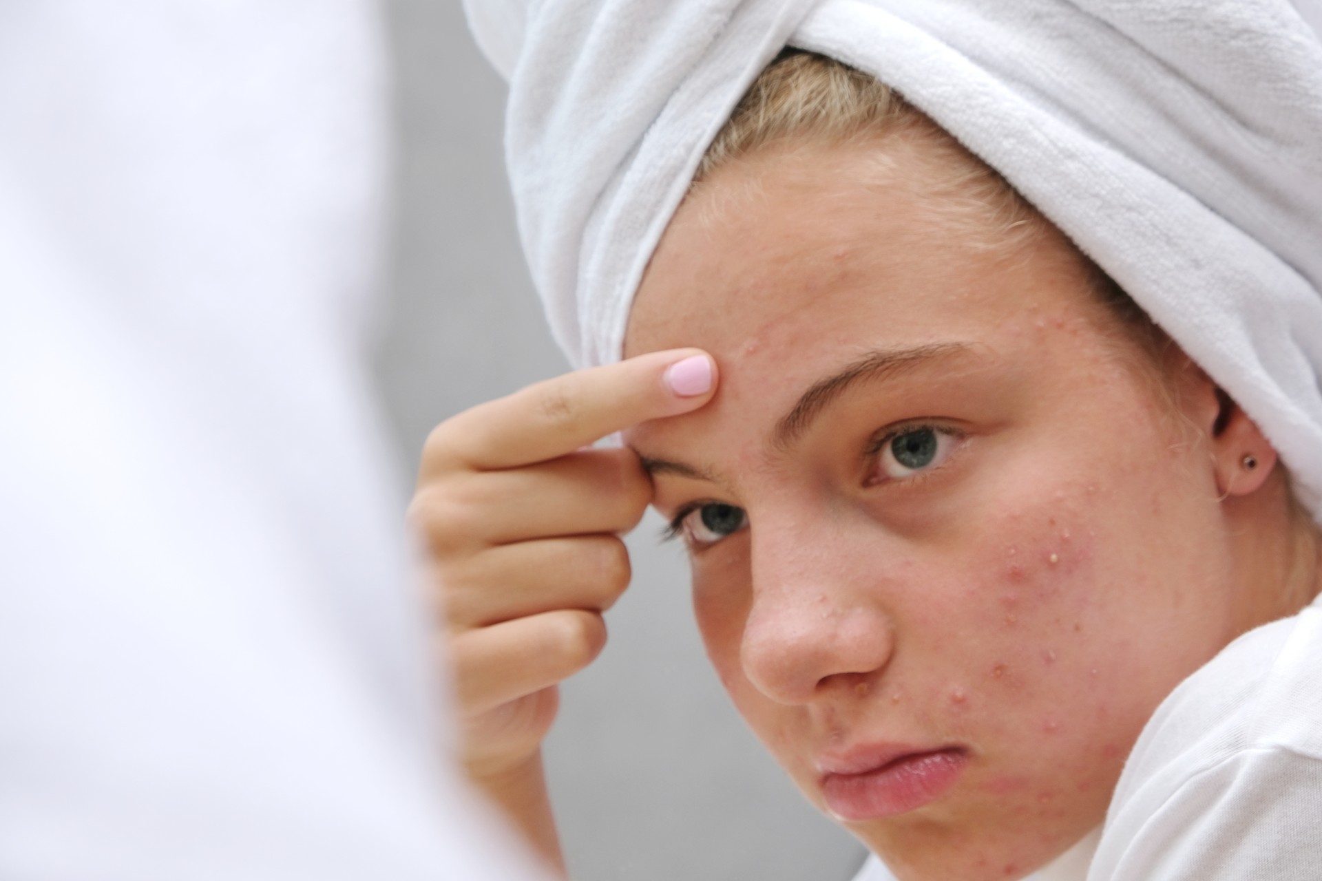 A sad teenage girl is looking at the pimples on her face in the mirror. Problematic skin. Acne.